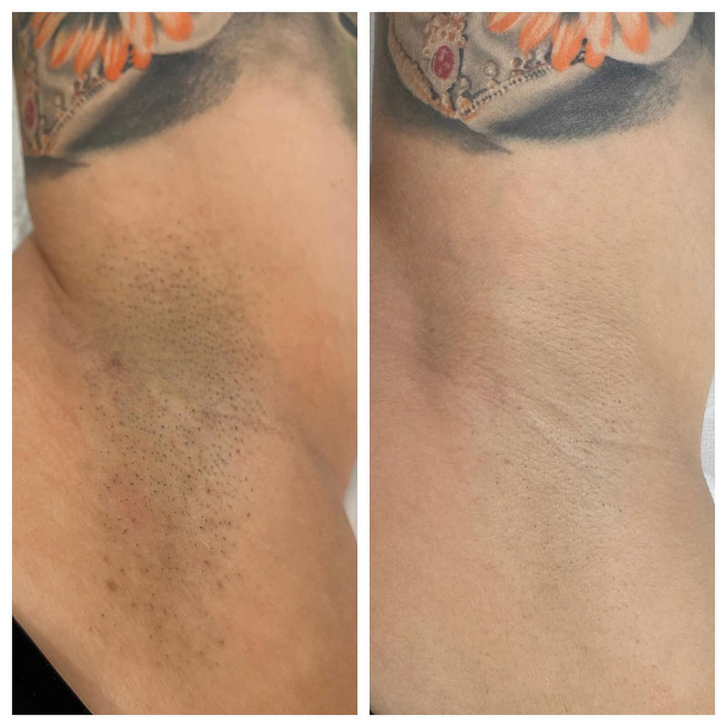 Customer before and after IPL hair removal — underarm area after 5 weeks
