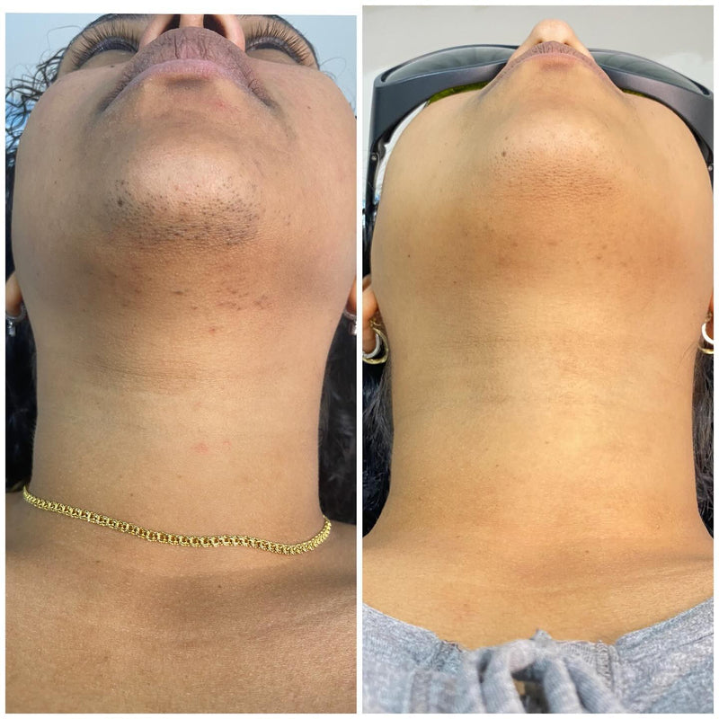 Customer before and after IPL hair removal — chin and jawline, Week 0 vs Week 8