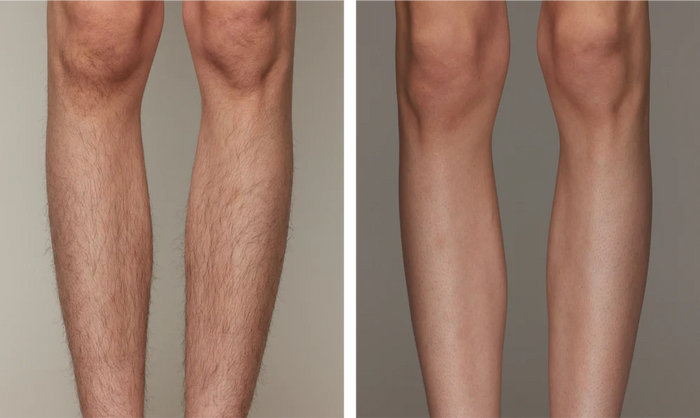 Before and After