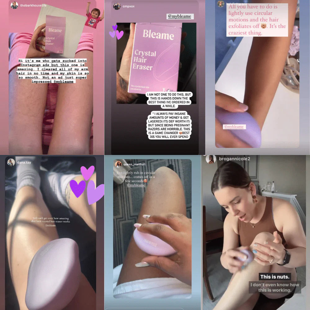 Before and after using Easemate Crystal Hair Eraser — smoother skin and reduced ingrown hairs