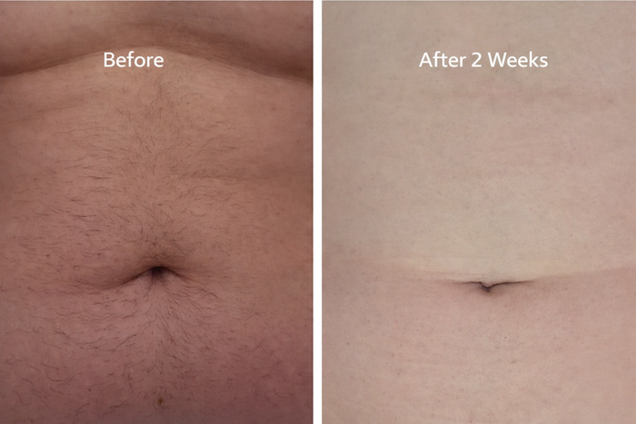 Before and After