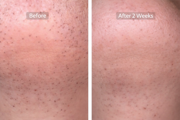 Before and After