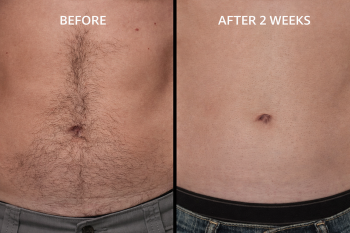 Before and After