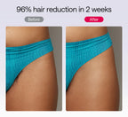Easemate IPL hair removal device being used on underarm area