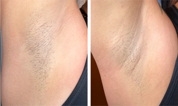 Before and After